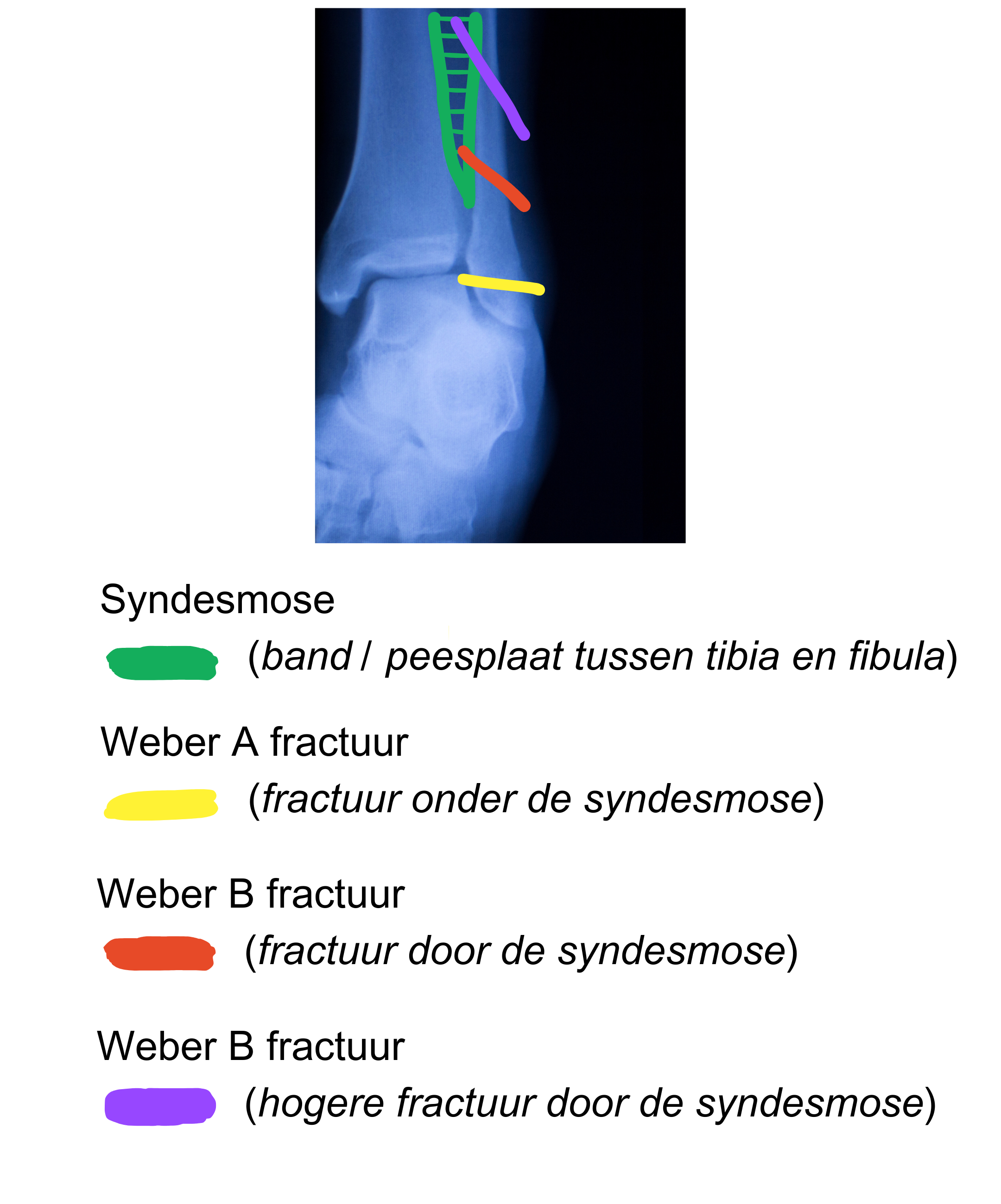 Type Weber fracturen